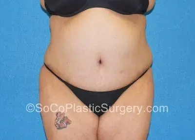 Tummy Tuck #19 after