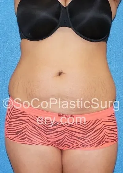 Tummy Tuck #4 before