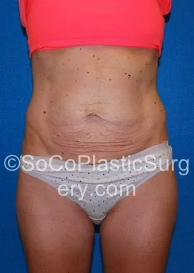 Tummy Tuck #18 before
