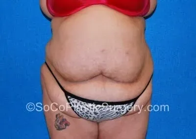 Tummy Tuck #19 before