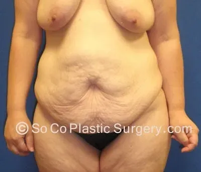 Tummy Tuck #14 before