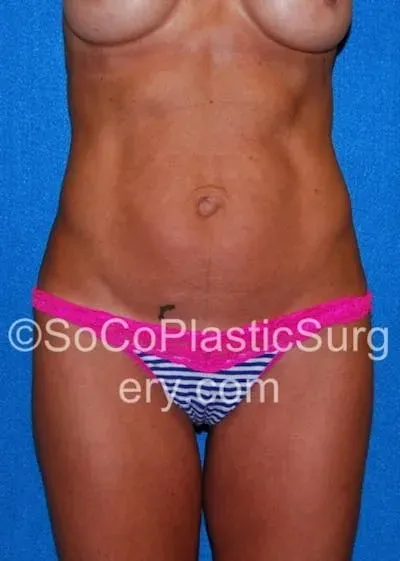 Tummy Tuck #13 before