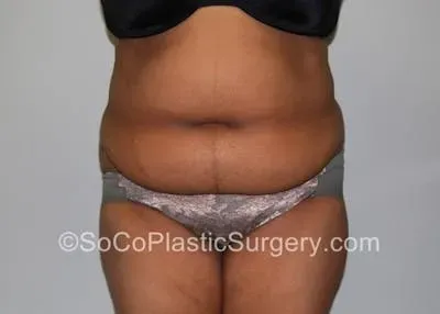 Tummy Tuck #12 before