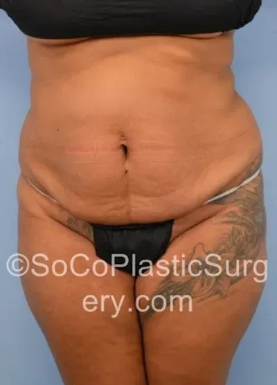 Tummy Tuck #17 before
