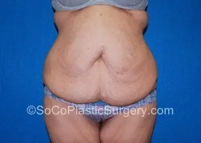 Tummy Tuck #15 before