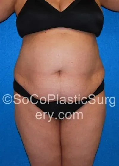 Tummy Tuck #20 before