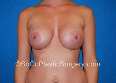 Breast Augmentation #14 after