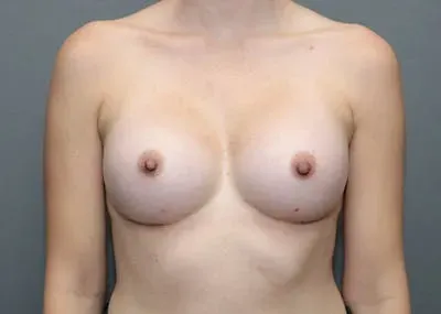 Breast Augmentation #7 after