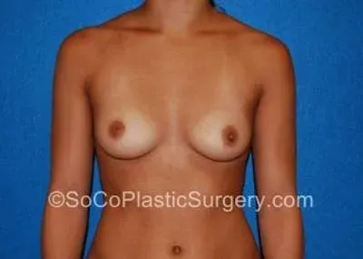 Breast Augmentation #9 before