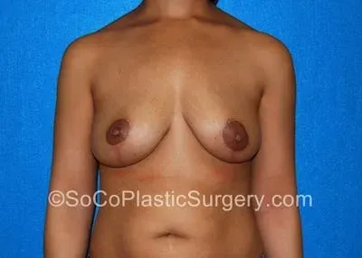 Breast Lift #7 after