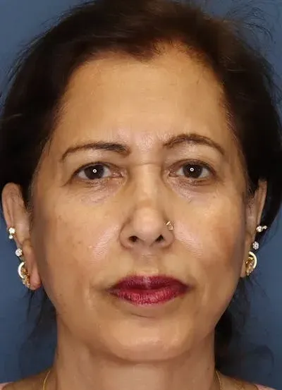 Facelift #10 after