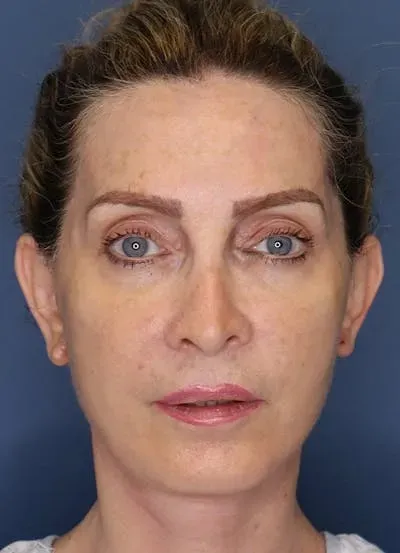 Facelift #4 after