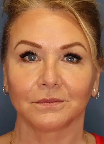 Facelift #2 after