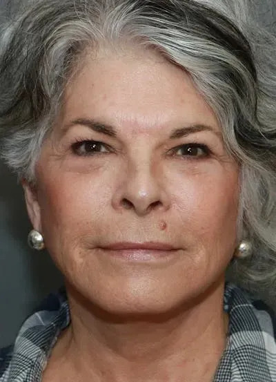 Facelift #7 after