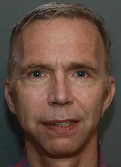 Facelift #8 after