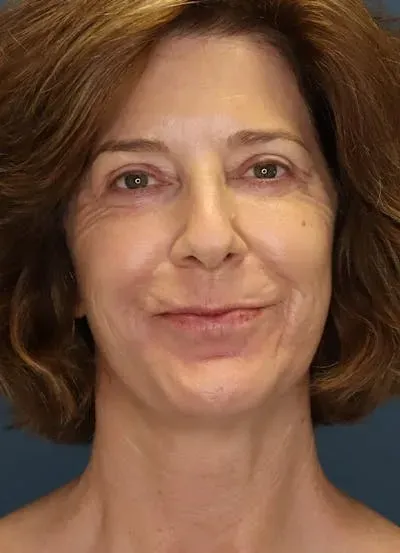 Facelift #6 after
