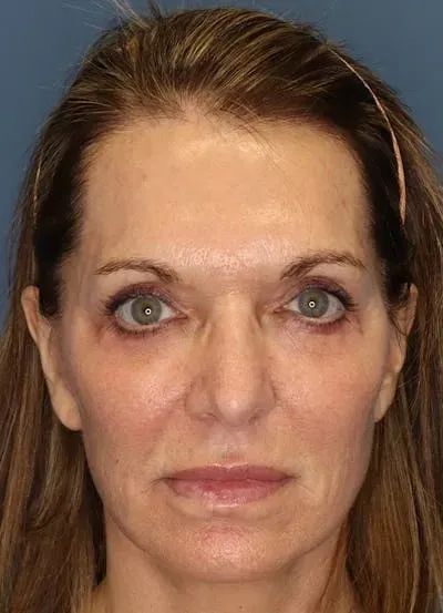 Facelift #3 after
