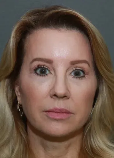 Facelift #5 after