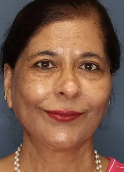 Facelift #9 after