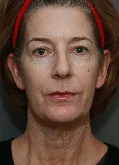 Facelift #6 before