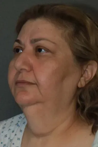 Facelift #1 before