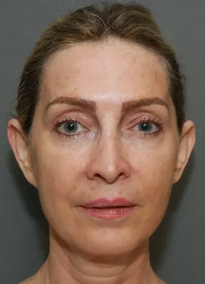 Facelift #4 before
