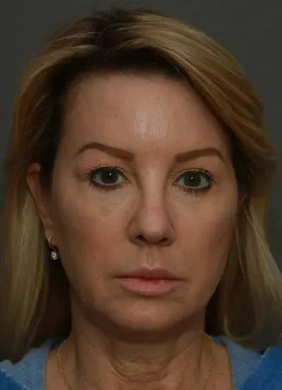 Facelift #5 before