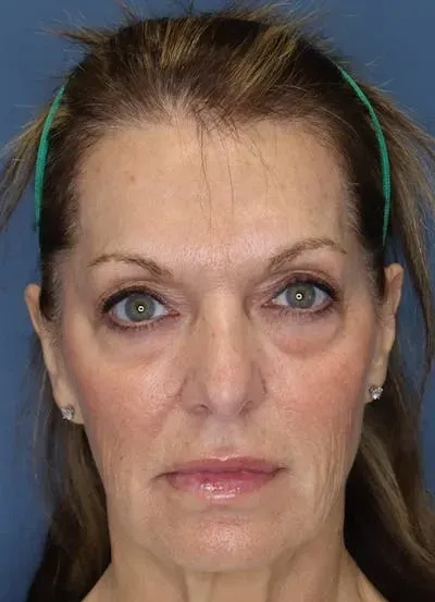 Facelift #3 before