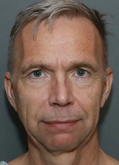 Facelift #8 before