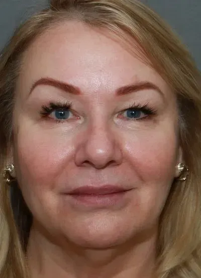 Facelift #2 before