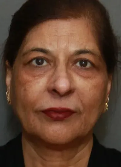 Facelift #9 before