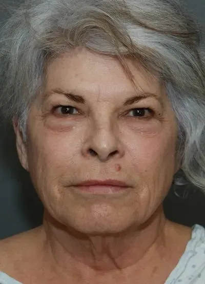 Facelift #7 before