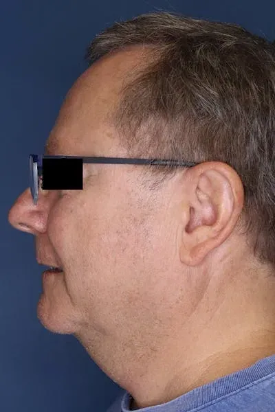 Neck Lift #1 before