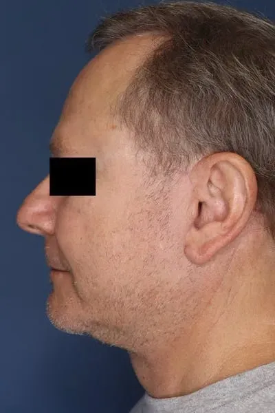 Neck Lift #1 after