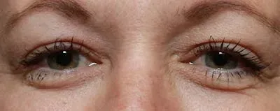 Upper Blepharoplasty #2 after