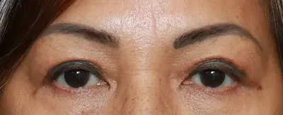 Upper Blepharoplasty #9 after