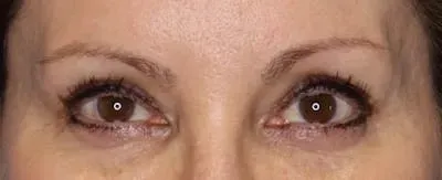 Upper Blepharoplasty #4 after