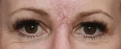 Upper Blepharoplasty #6 after