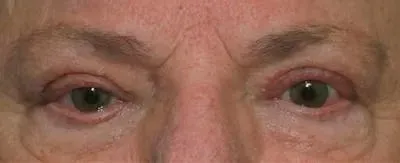 Upper Blepharoplasty #7 after