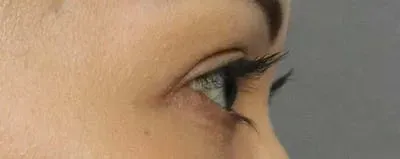 Upper Blepharoplasty #1 after