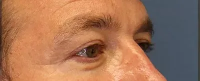 Upper Blepharoplasty #8 after