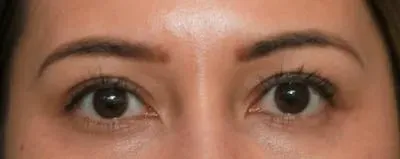 Upper Blepharoplasty #3 after