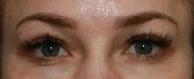 Upper Blepharoplasty #5 after