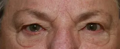 Upper Blepharoplasty #7 before