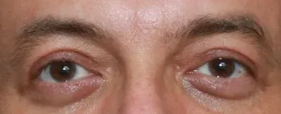 Upper Blepharoplasty #10 after