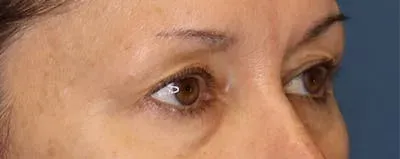 Upper Blepharoplasty #11 before