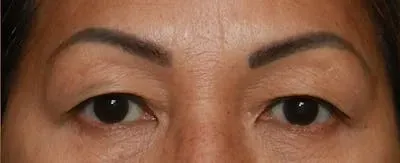 Upper Blepharoplasty #9 before