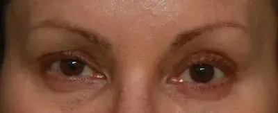 Upper Blepharoplasty #4 before