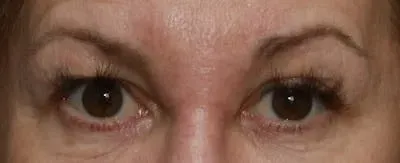 Upper Blepharoplasty #6 before