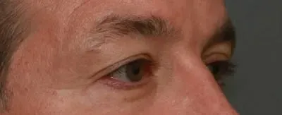 Upper Blepharoplasty #8 before